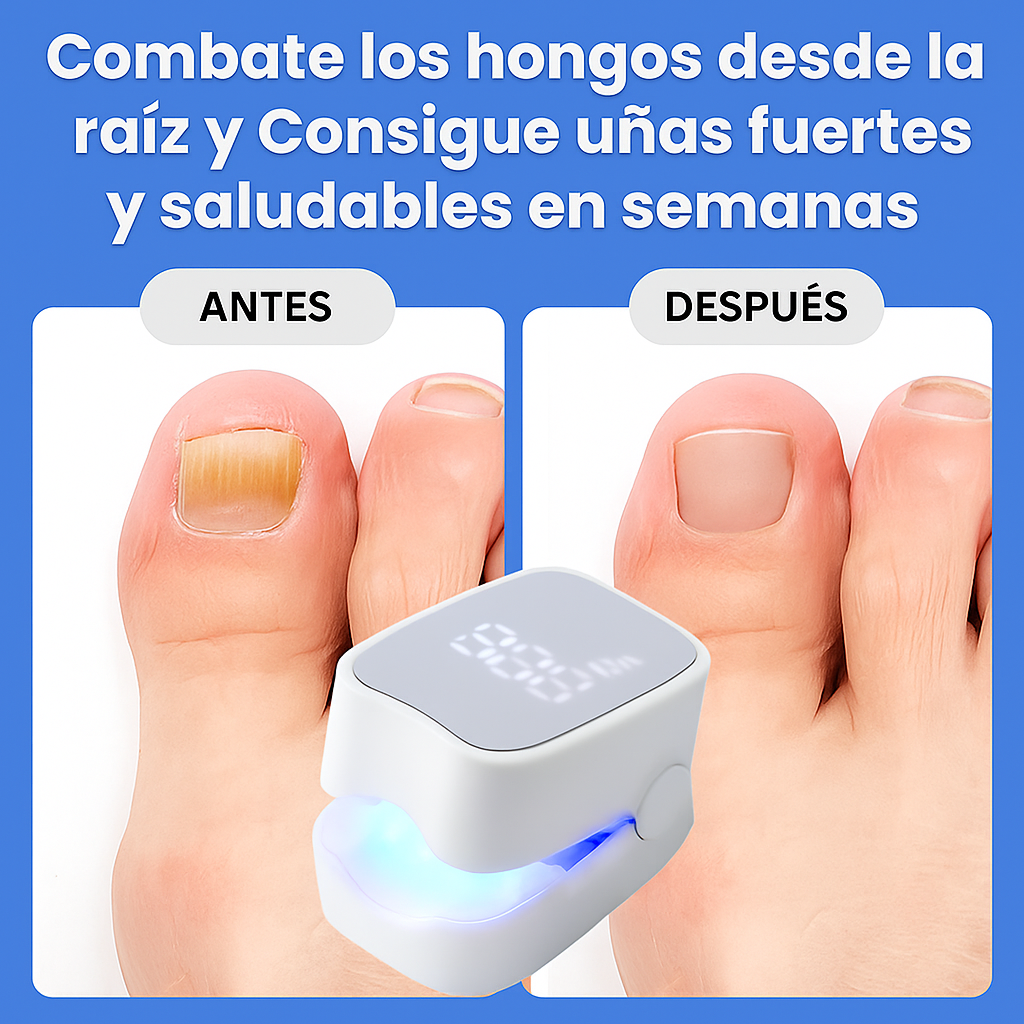 MycoLáser™ – Dispositivo Láser Antihongos para Uñas