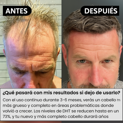 BioAQUA™ - Solución alopecia