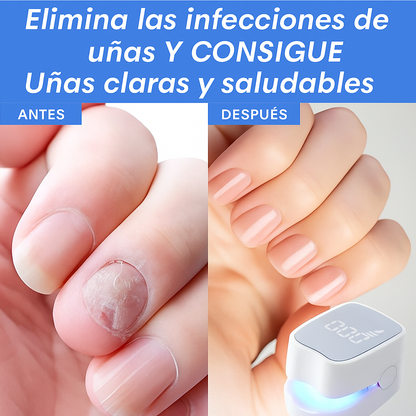 MycoLáser™ – Dispositivo Láser Antihongos para Uñas