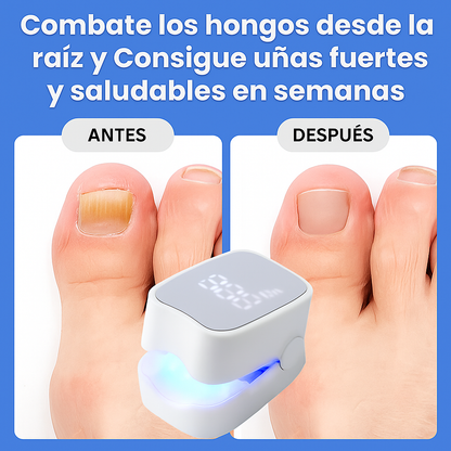 MycoLáser™ – Dispositivo Láser Antihongos para Uñas
